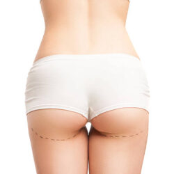 Body Fillers – Buttock Implants in Dubai