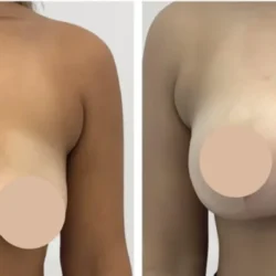 Breast lift in Dubai