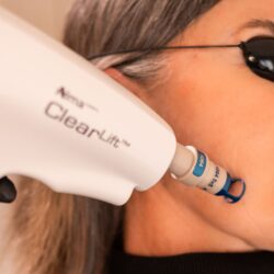 Is ClearLift Laser Safe for Sensitive and Darker Skin Tones?