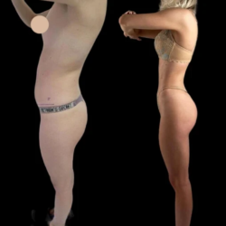 J-Plasma Skin Tightening Treatment Dubai