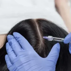 prp for hair loss
