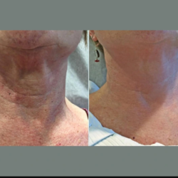 Skin Tightening Treatment In Dubai