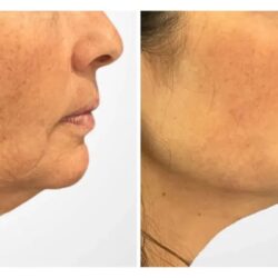 Achieve Firmer, Tighter Skin Quickly with Thread Lift Treatment in Dubai
